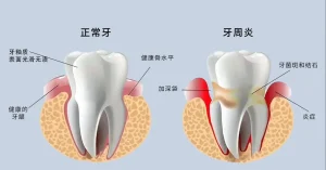 警惕“隐形杀手”：牙周病初期症状易被忽视，预防与治疗全解析